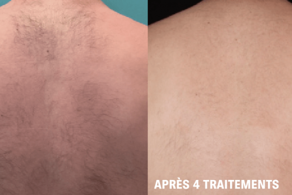 hair removal fr 1@4x