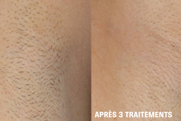 hair removal fr 2@4x