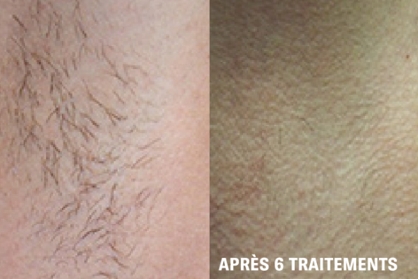 hair removal fr 3@4x